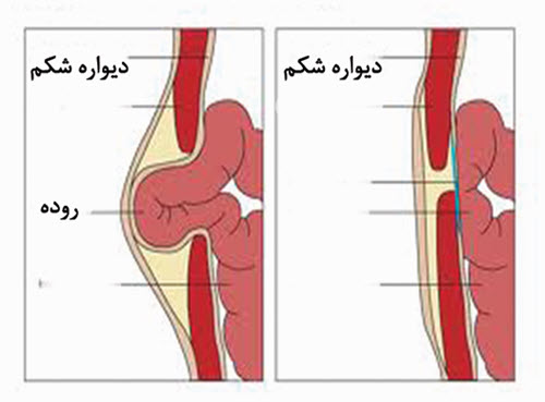 فتق كشاله ران